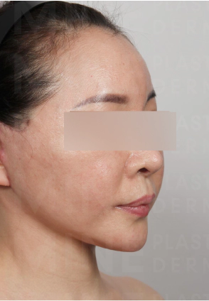 Aged woman with tight jawline and overall lifted face after Korean facelift and Korean neck lift.