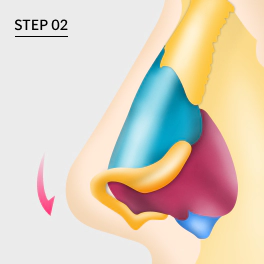 Repositioning nose cartilage for upturned nose.