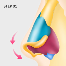 In order to correct upturned nose we use septal cartilage.