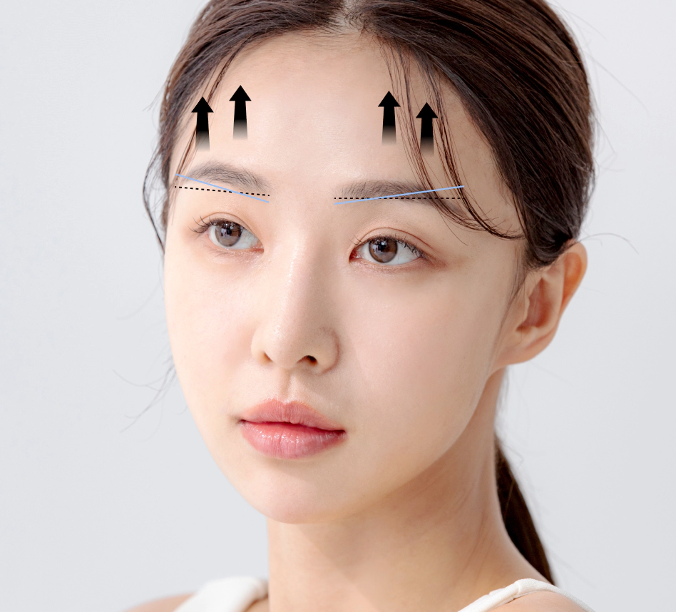Illustration of how an endoscopic brow lift raises the eyebrow line (model photo with drawn guide lines)
