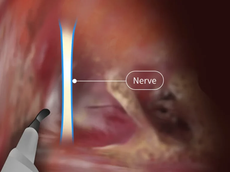 Nerve preserved during endoscopic transaxillary breast augmentation