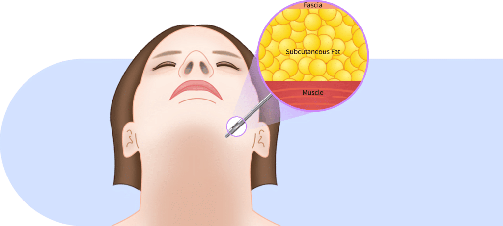 Subcutaneous fat removal that is done during mini neck lift for Korean jawline lifting.