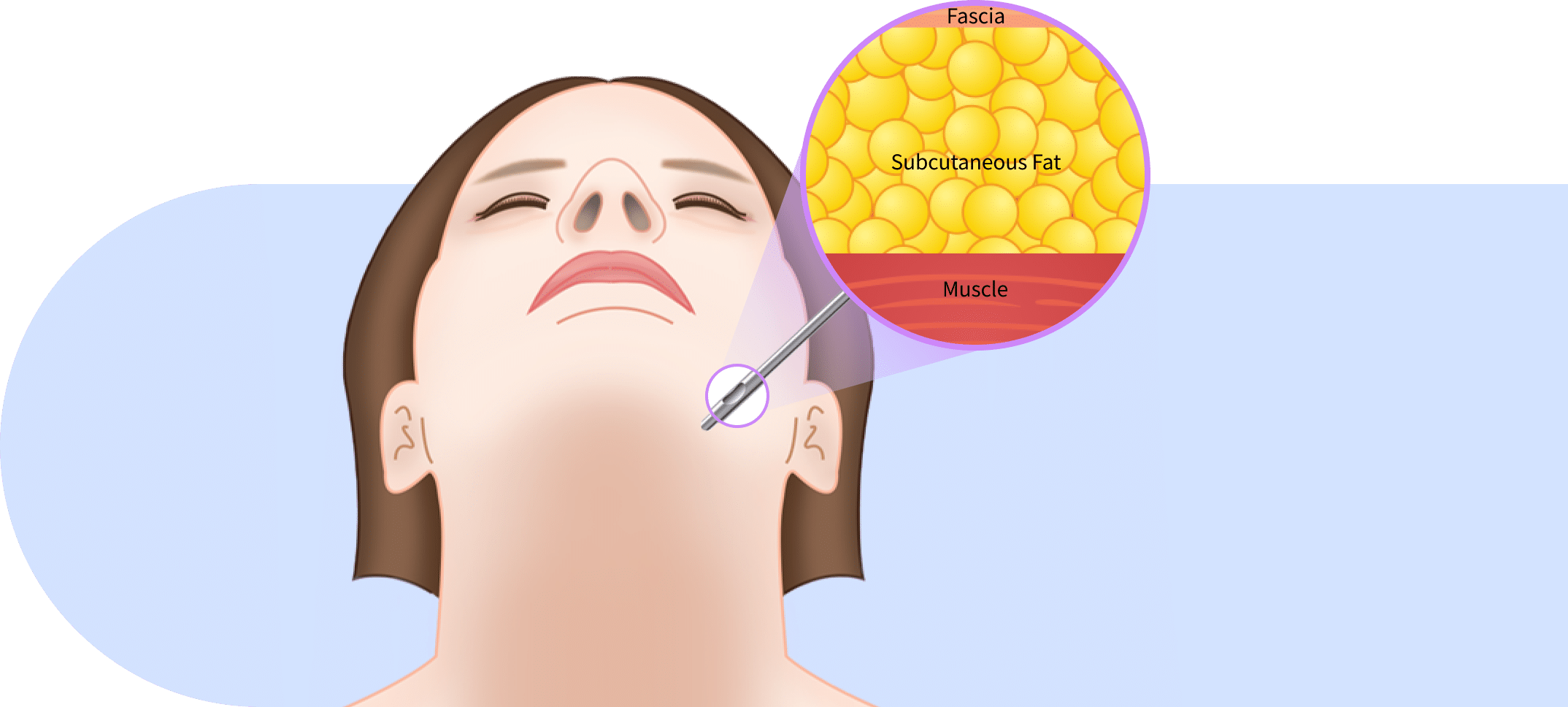 Subcutaneous fat removal that is done during mini neck lift for Korean jawline lifting.