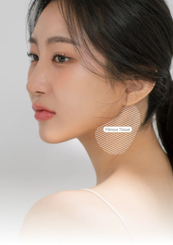 Location of fibrous tissue in mini neck lift for Korean jawline lifting.