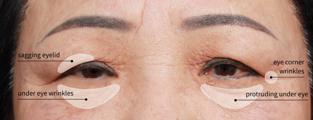 Areas which are improved with lower blepharoplasty surgery.