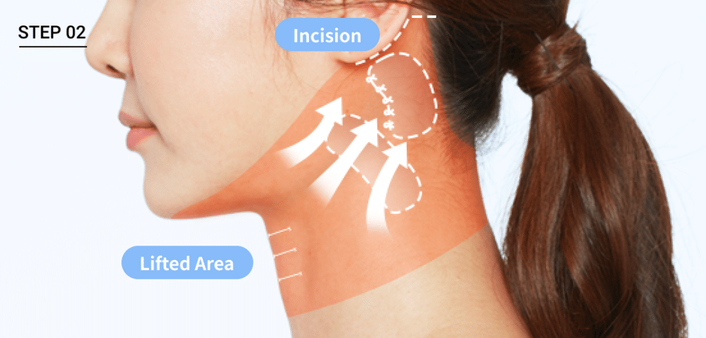 Lifting muscle to behind ear for Korean jawline lifting effect through mini neck lift surgery.