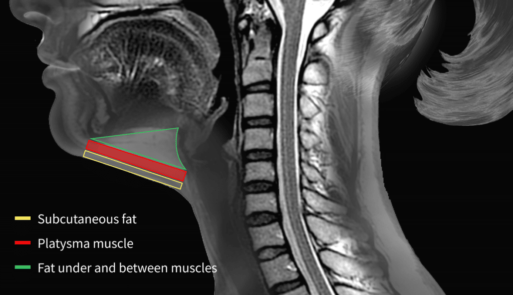 MRI of double chin.