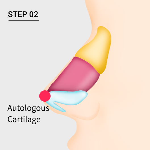Dorsal hump nose with raised nose tip using cartilage.