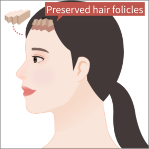 Hair roots are preserved during forehead reduction surgery.