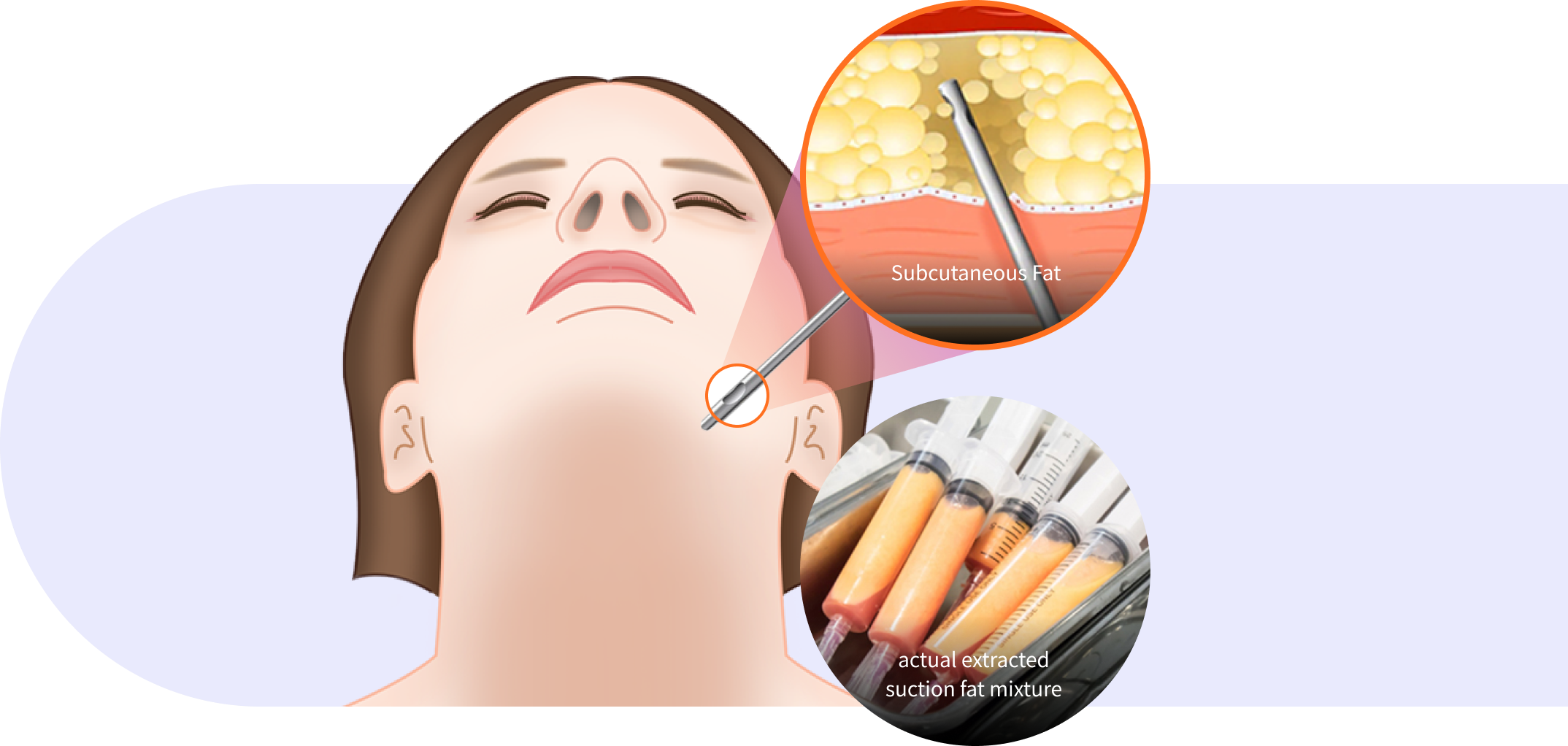 Subcutaneous fat removal step in Korean double chin surgery.