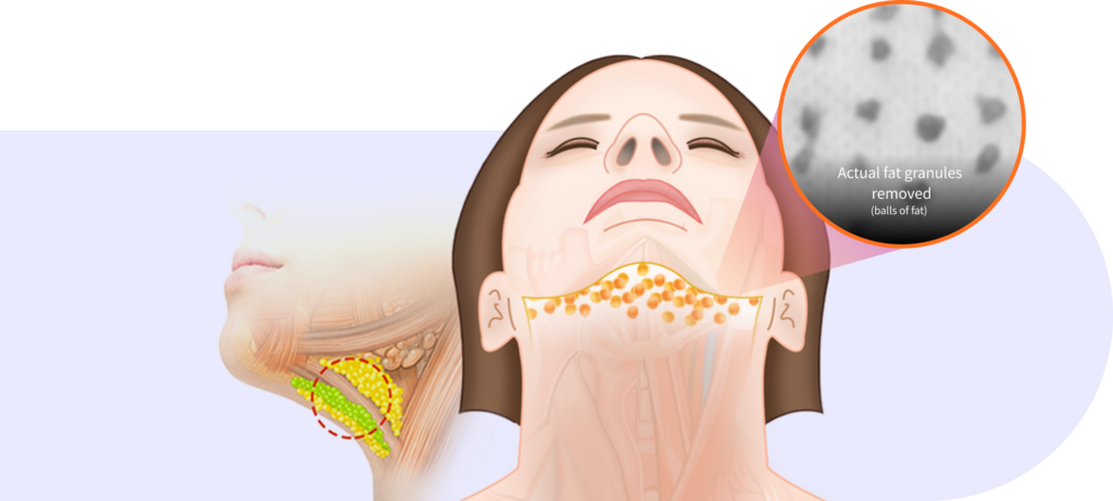 Fat granule removal step in Korean double chin surgery.