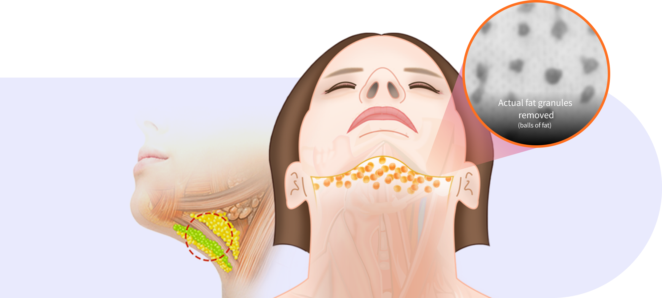 Fat granule removal step in Korean double chin surgery.