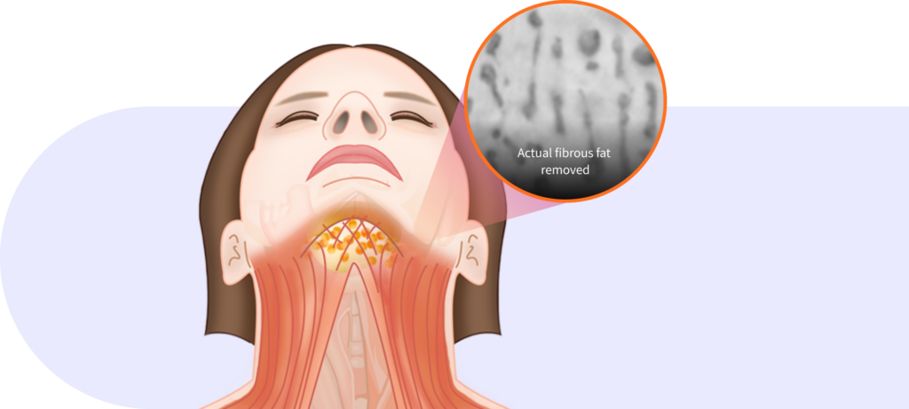 In between muscle fat removal step in Korean double chin surgery.
