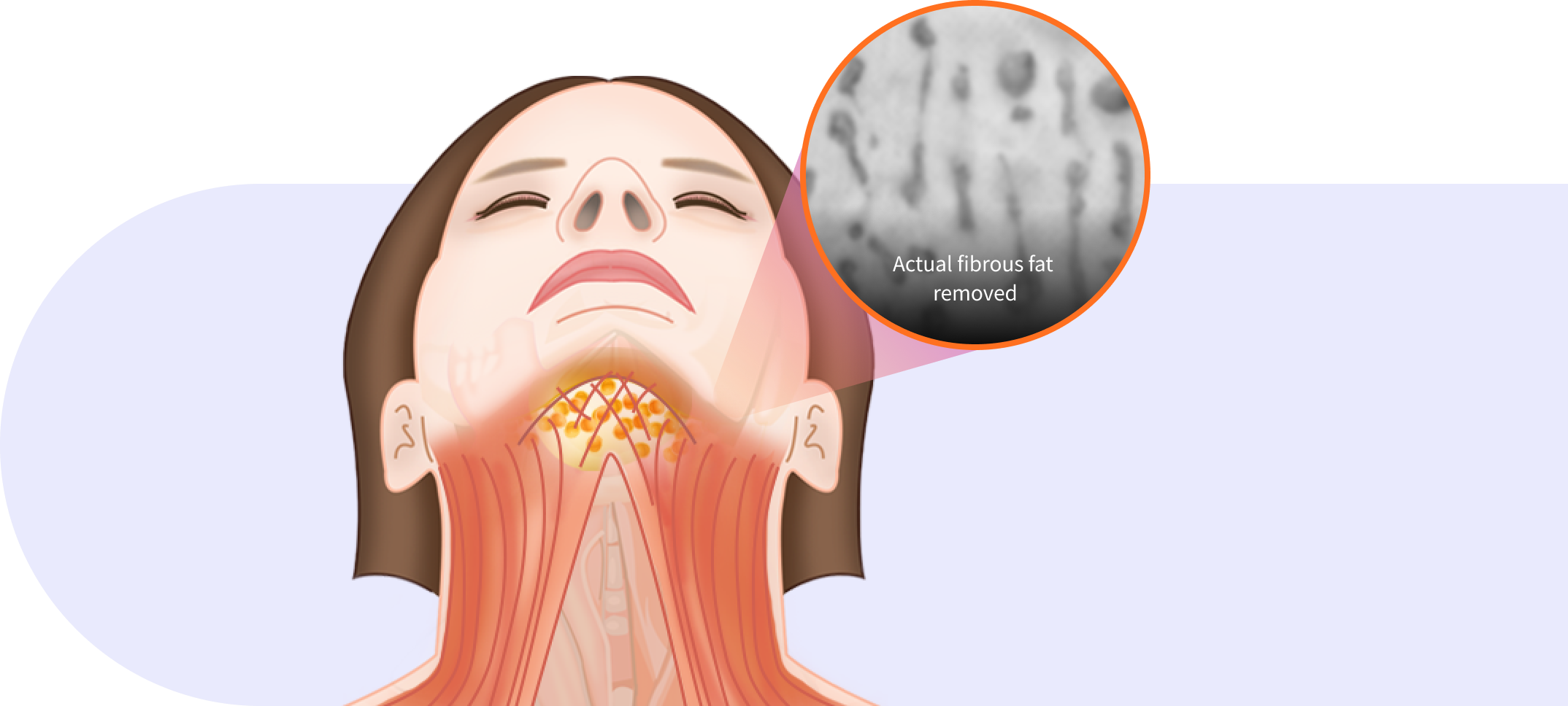 In between muscle fat removal step in Korean double chin surgery.
