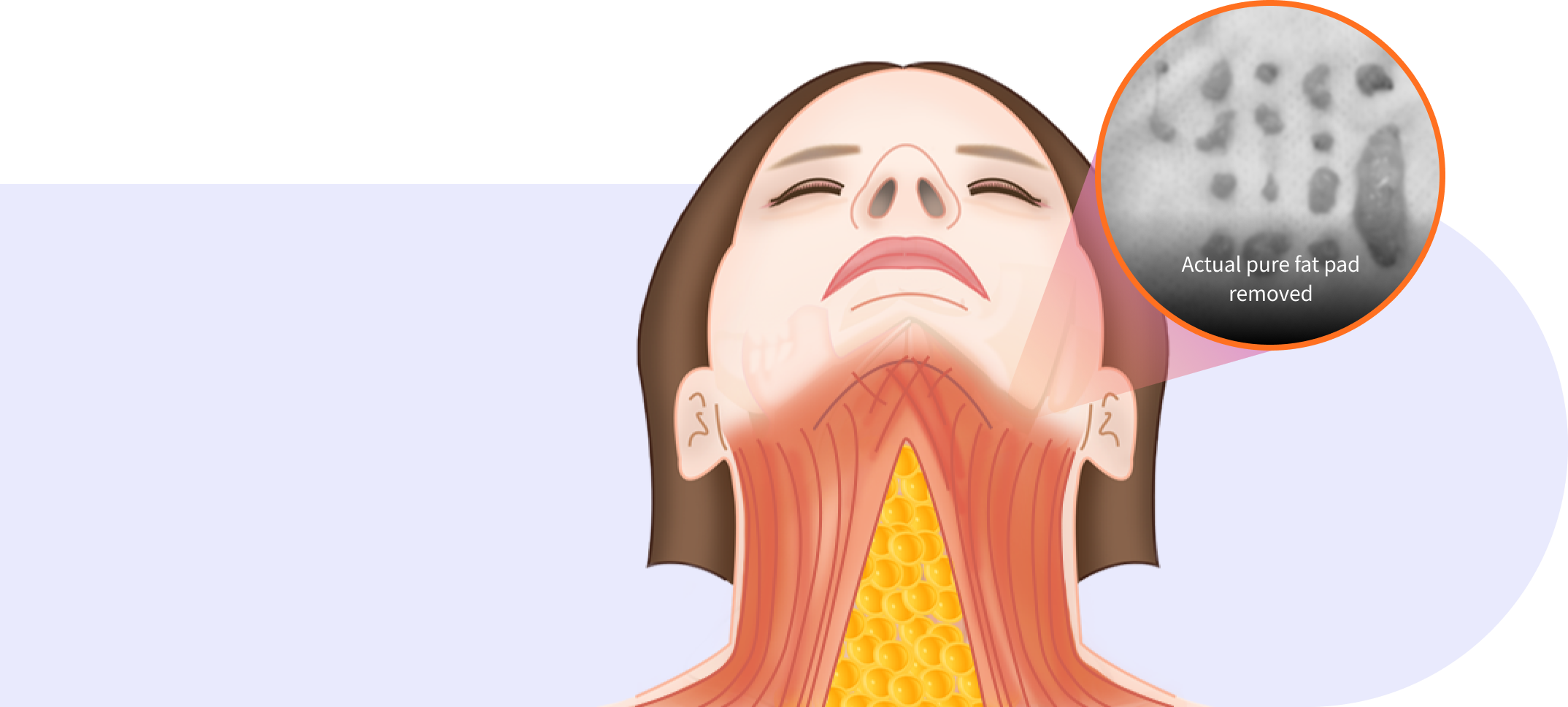 In between muscle fat pad removal step in Korean double chin surgery.