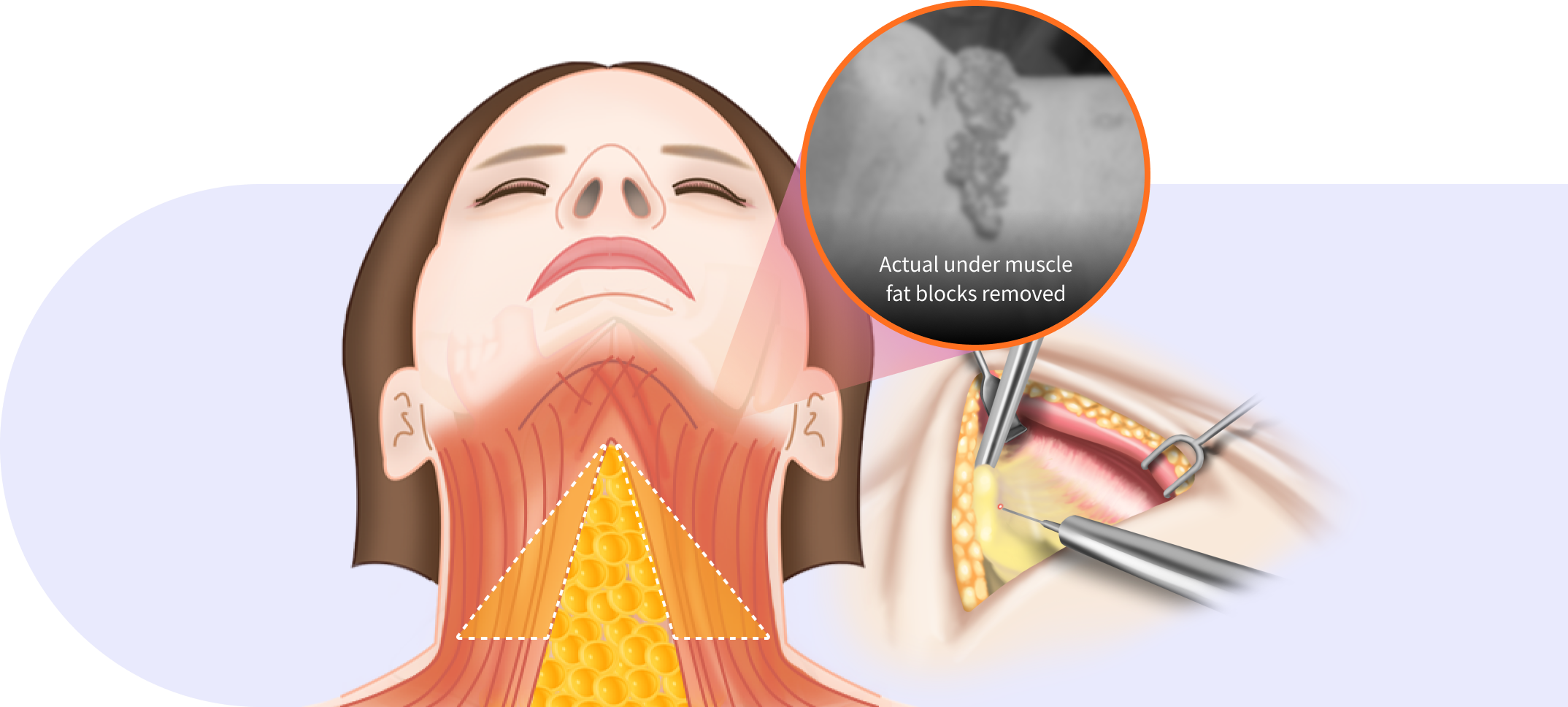 Fat block removal step in Korean double chin surgery.