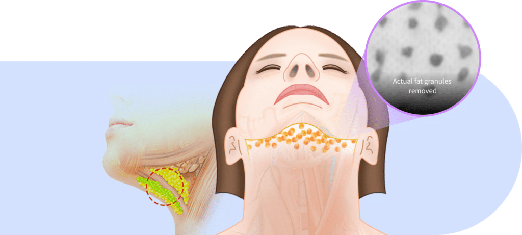 Under fascia fat removal for mini neck lift for Korean jawline lifting.