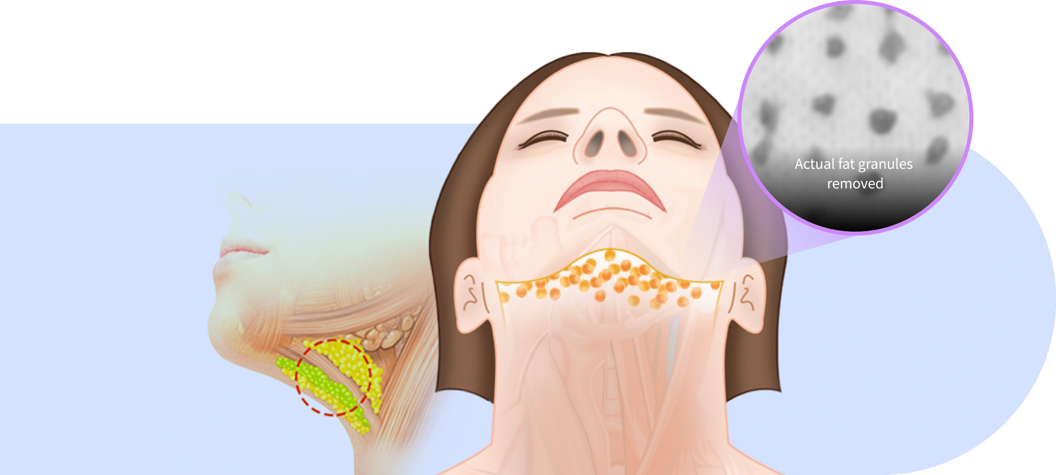 Under fascia fat removal for mini neck lift for Korean jawline lifting.