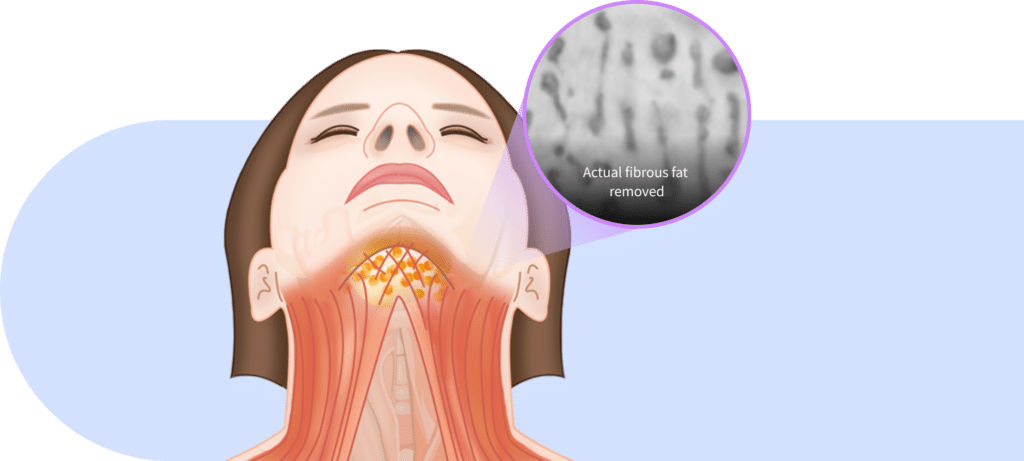 Behind muscle fat removal for mini neck lift for Korean jawline lifting.