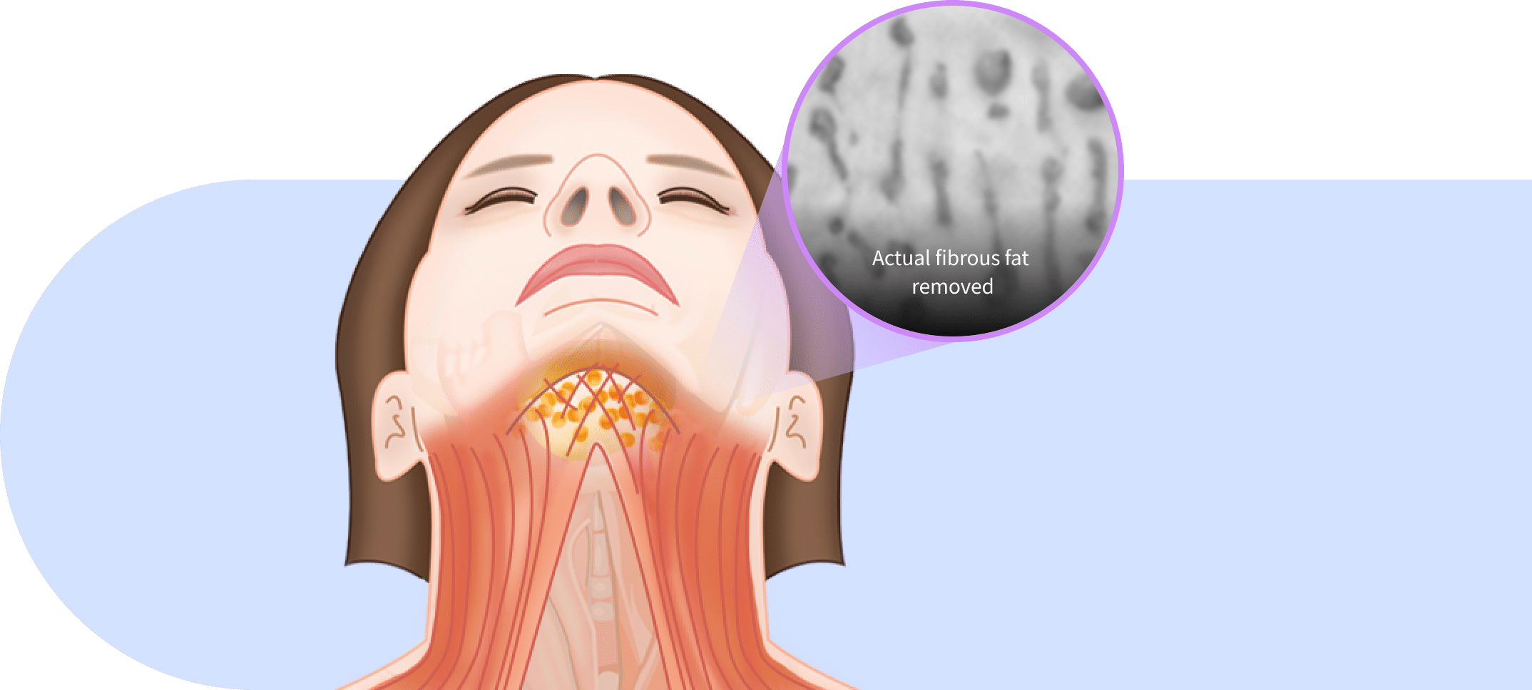 Behind muscle fat removal for mini neck lift for Korean jawline lifting.
