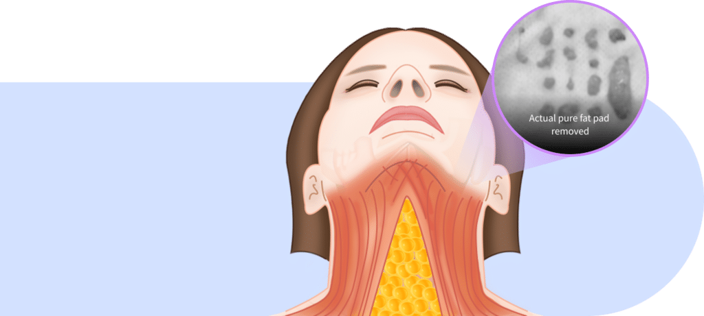 Fat pad removal for mini neck lift for Korean jawline lifting.