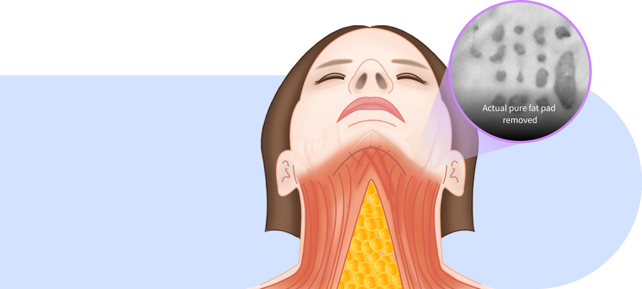 Fat pad removal for mini neck lift for Korean jawline lifting.