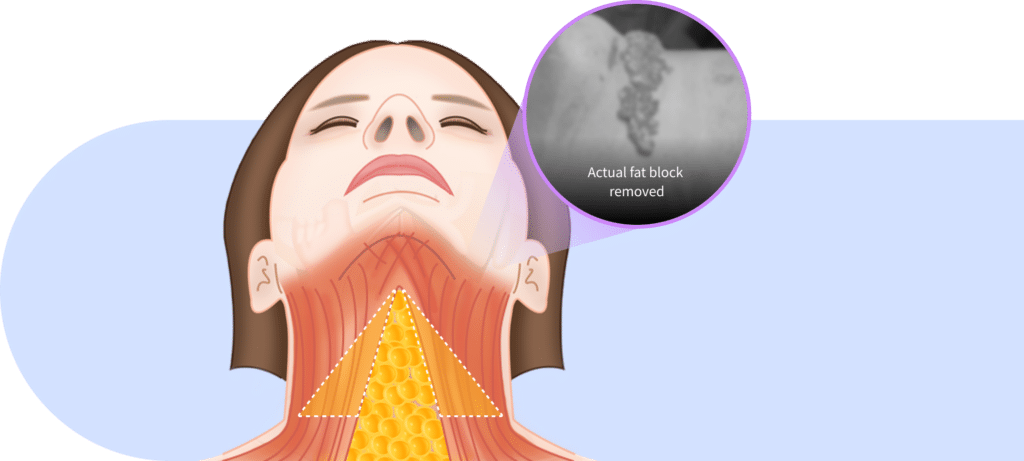 Fat block removal for mini neck lift for Korean jawline lifting.