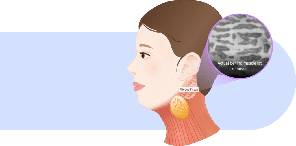 Behind muscle fat strip removal for double chin and mini neck lift surgery for jawline lifting.