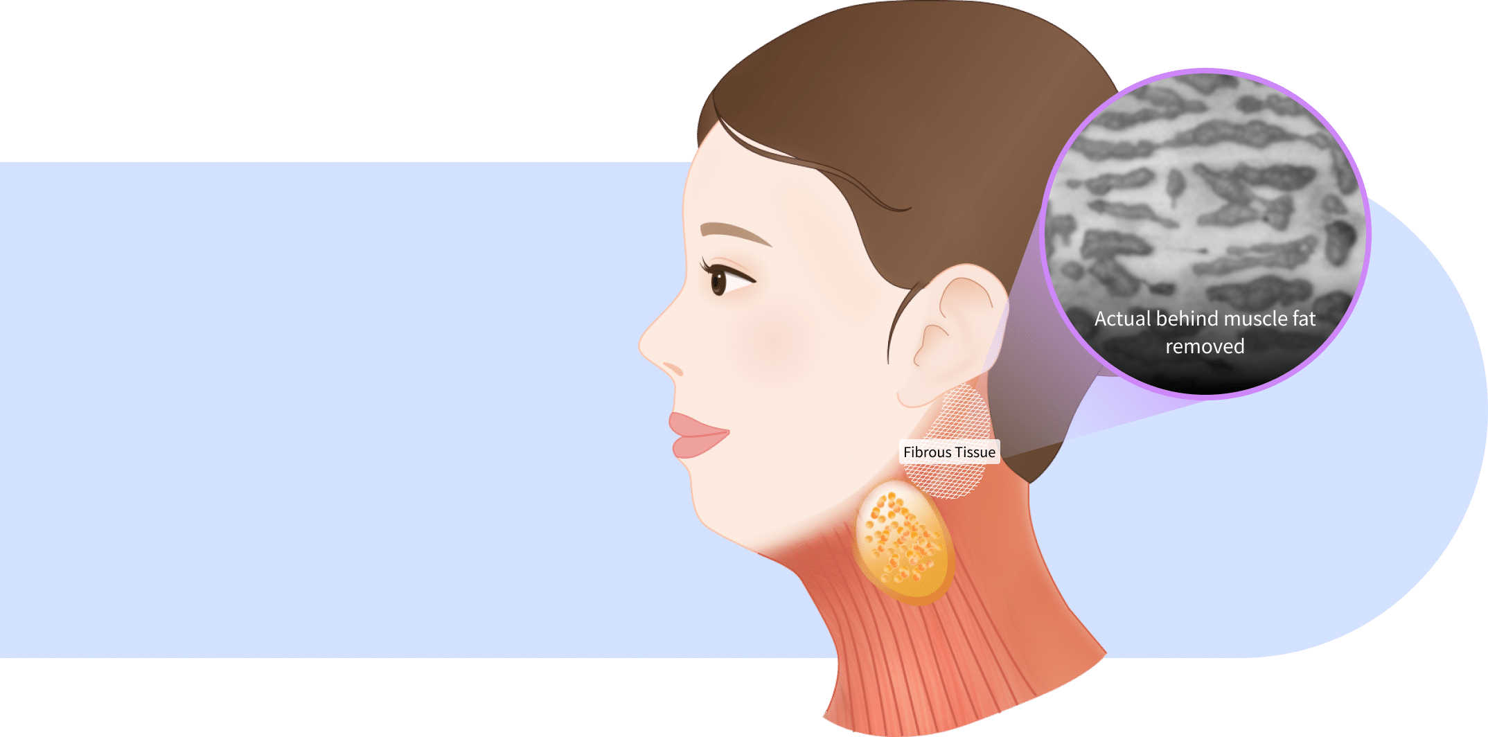 Behind muscle fat strip removal for double chin and mini neck lift surgery for jawline lifting.