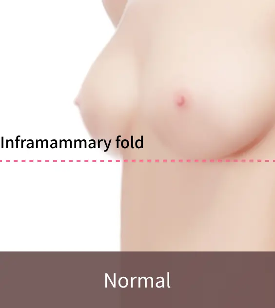 Normal position of Inframammary fold that doesn't need Korean breast lift.