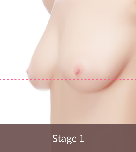 Stage 1 sagging where nipple is same as inframammary fold in need of slight correction through Korean breast lift.