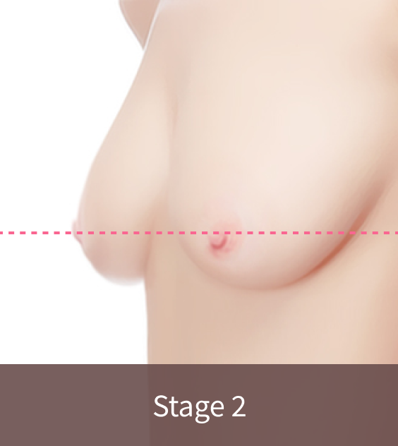 Korean breast lift Stage 2 sagging where nippled is slightly below the fold.