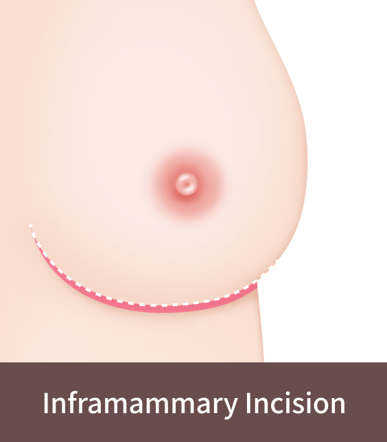 Inframammary incision for Korean breast lift surgery.