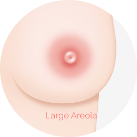 Large areola that is good candidate for areola reduction.