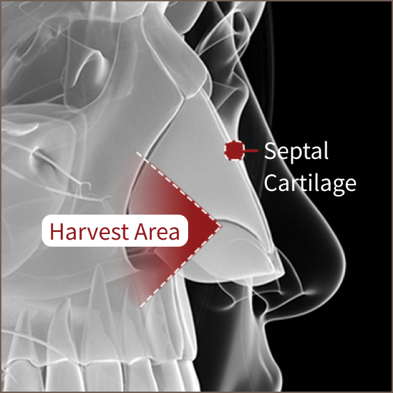 Septal cartilage used for nose revision rhinoplasty.