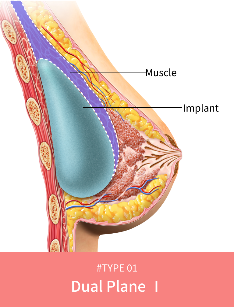Korean breast lift dual plane classification level 1.