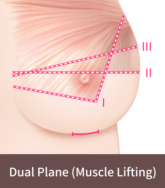 How dual plane muscle lifting is done during Korean breast lift surgery.
