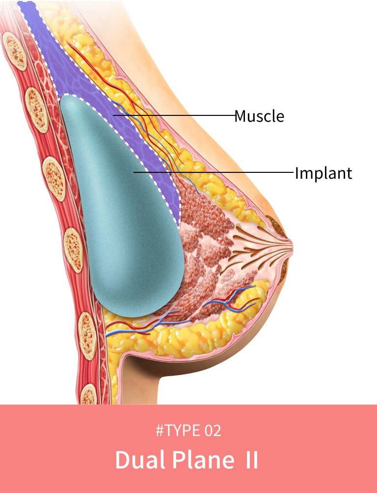 Korean breast lift dual plane classification level 2 for medium sagging.