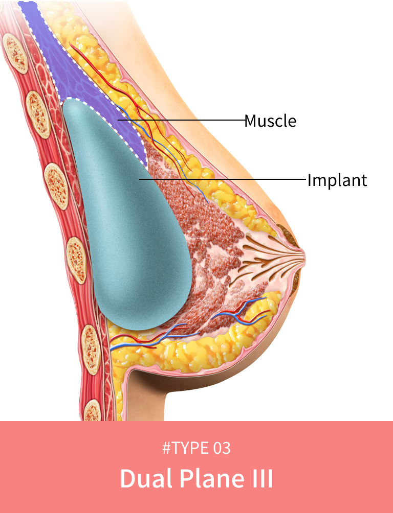 Korean breast lift dual plane classification level 3 for severe sagging.