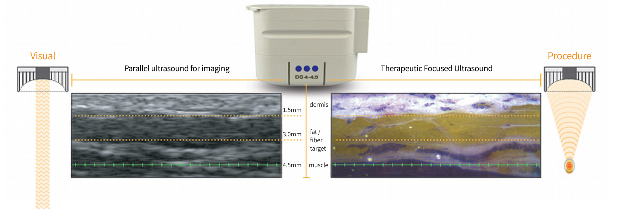 Laser diagram of how deep it reaches the skin during Ulthera lifting laser.