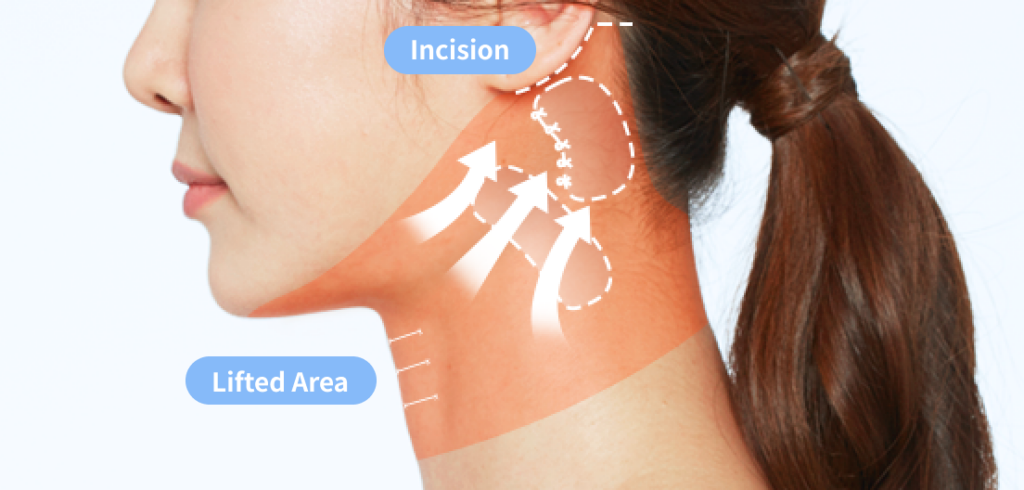 How the muscle is tightened and pulled during Korean neck lift surgery.