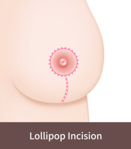 Korean Breast Lift lollipop incision method.