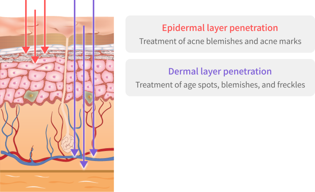 How deep the laser goes for skin brightening.