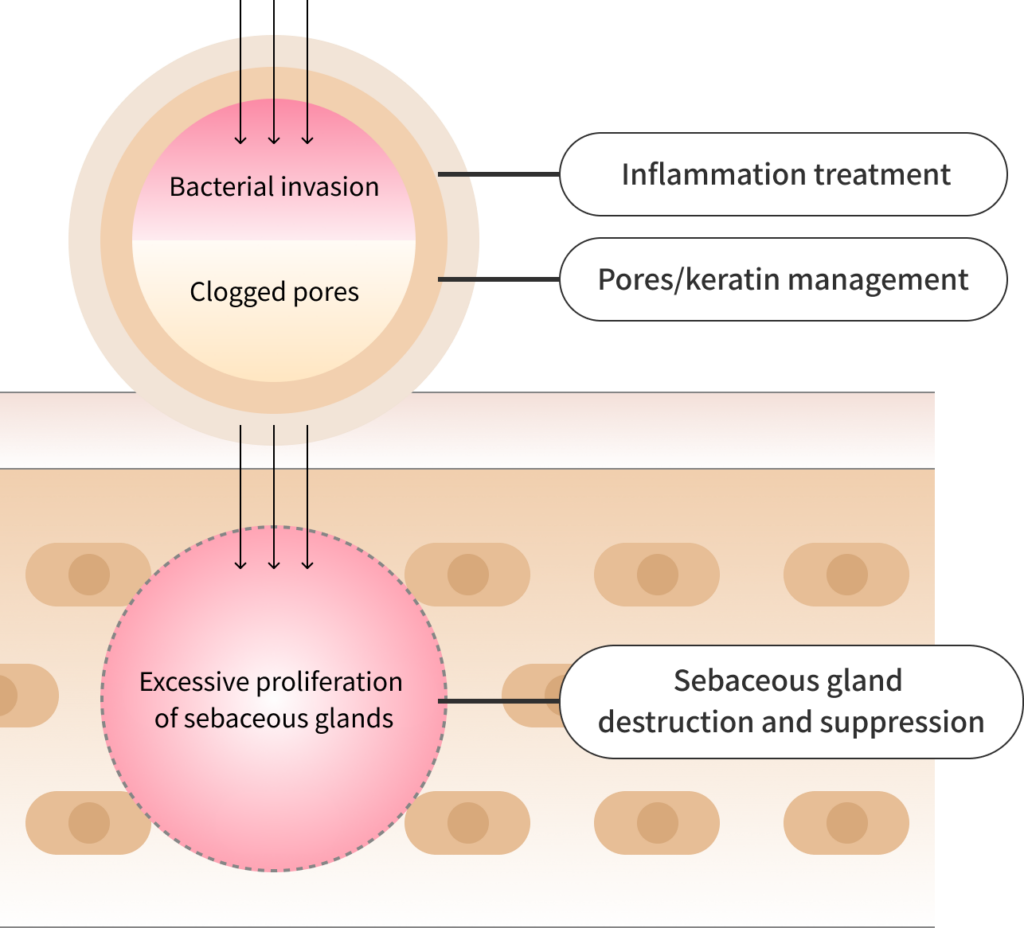 Diagram of how acne forms.
