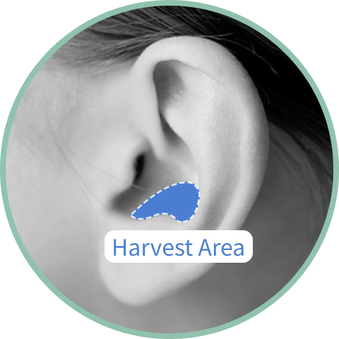 Ear cartilage harvest area for revision rhinoplasty.