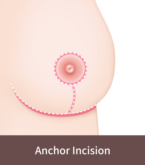 Korean Breast Lift anchor incision method.