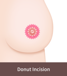 Donut shape incision for Korean breast lift surgery.