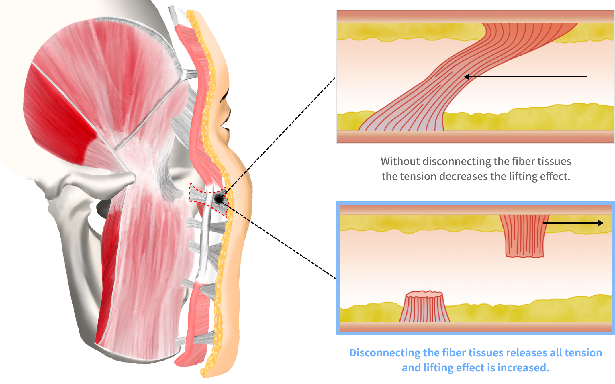 Face ligaments connecting skin and smas that need to be disconnected for Korean facelift and neck lift surgery.