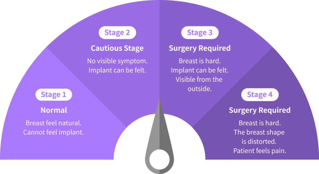 Graph explaining stages of Korean breast revision surgery.