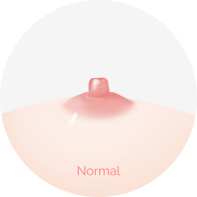 Normal nipple shape that does not need Korean nipple reduction.